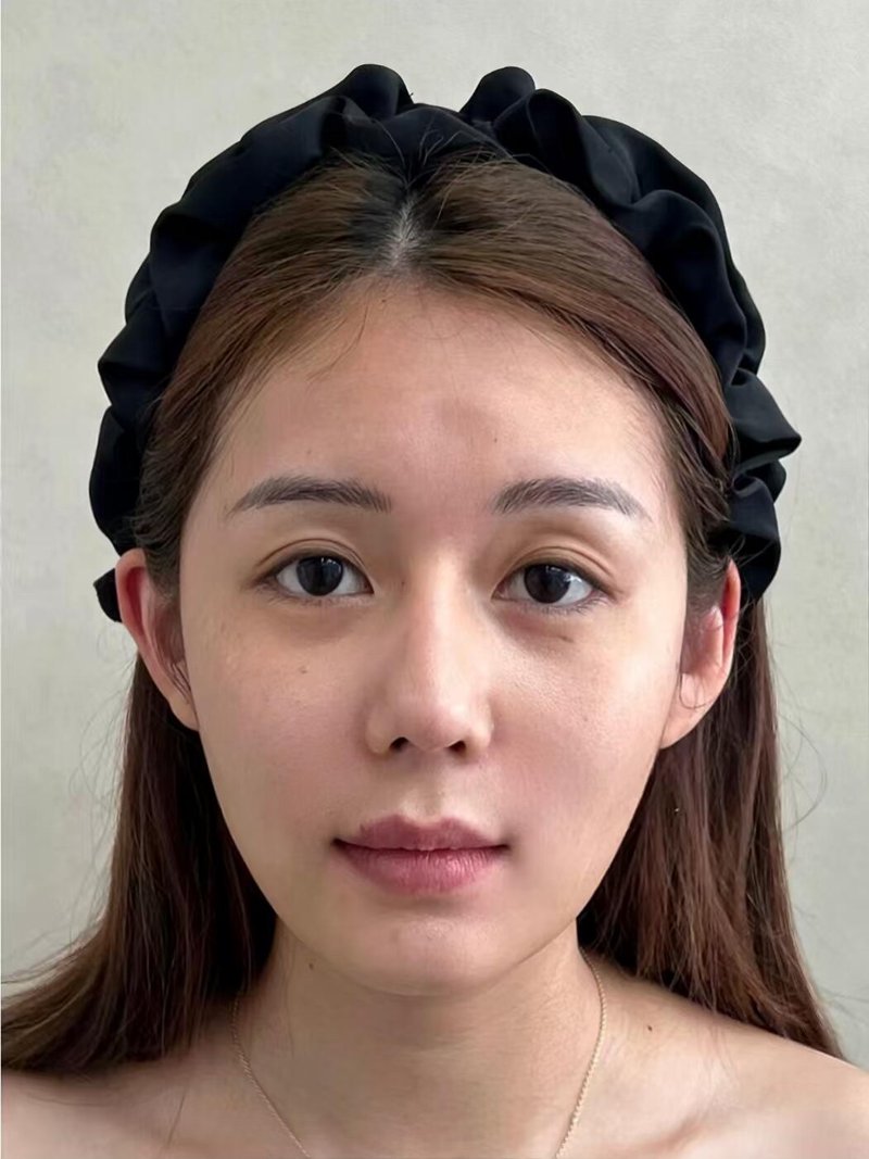 现代美眼趋势:双眼皮手术的新潮流