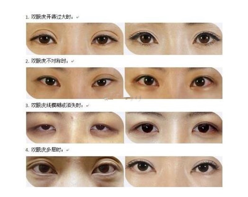 从自然美到精致美的变迁——隆鼻热风中的行业动态